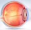 Stem cell therapy to treat macular degen
